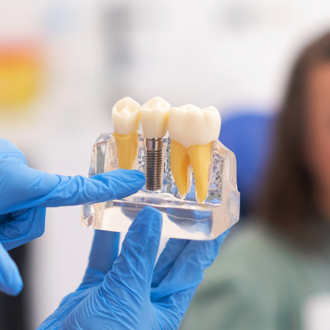 Dental Implant Maintenance: Essential Tips for Long-Lasting Results